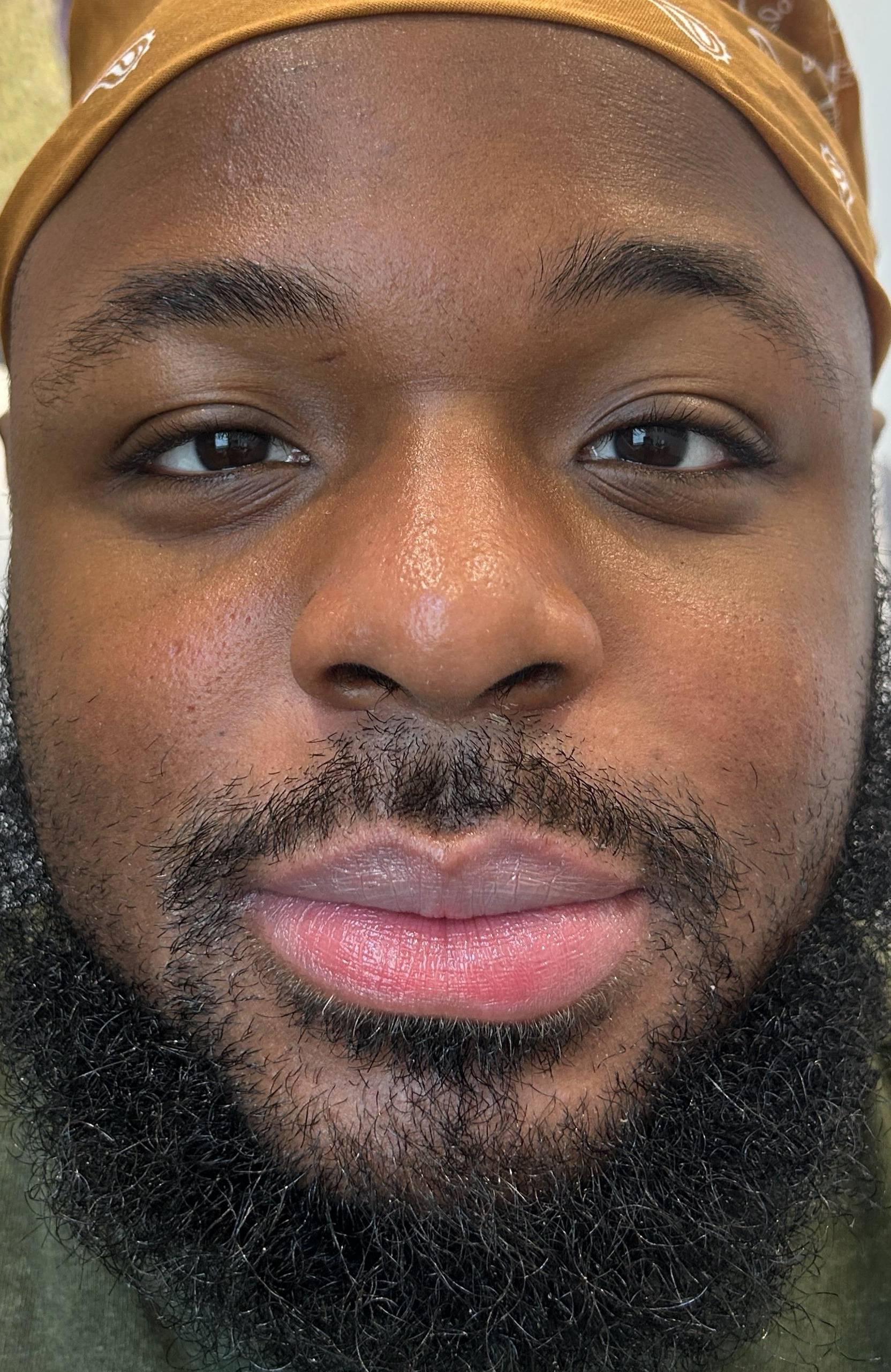 Acne Before and After Case 37 After
