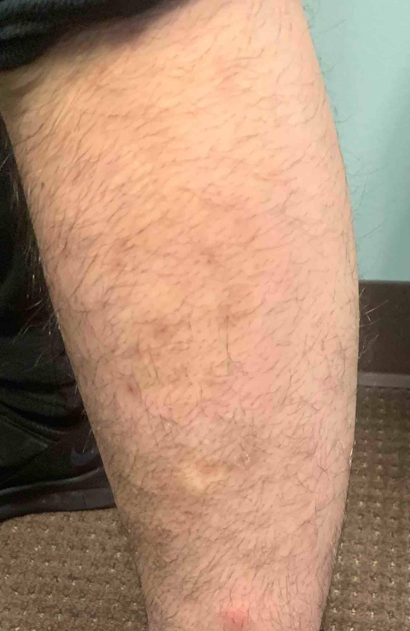 Psoriasis Before and After Case 17 After