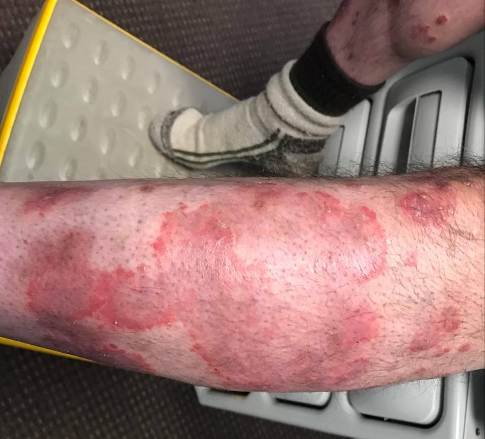 Psoriasis Before and After Case 18 Before