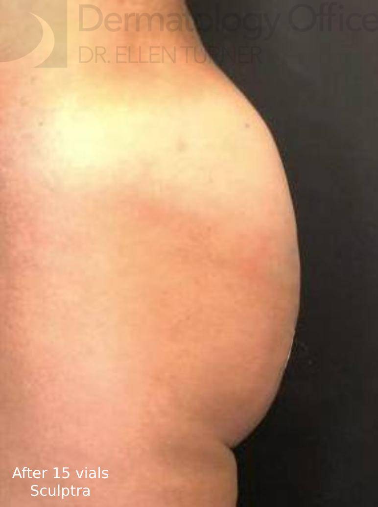 Sculptra (15 Vials) Before and After Case 3 After