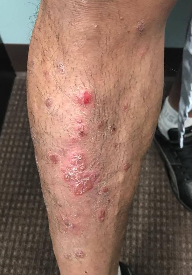 Psoriasis Before and After Case 23 Before
