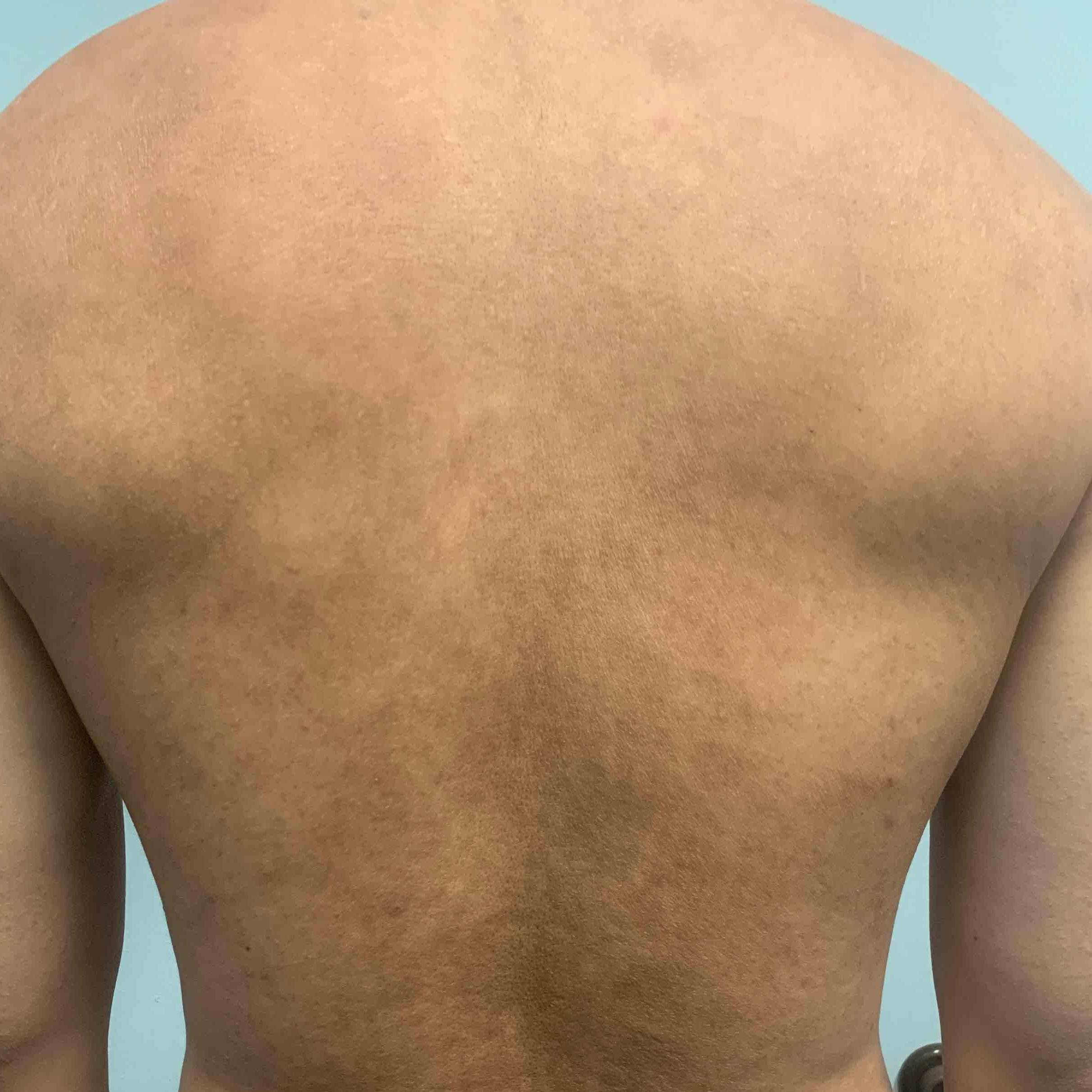 Eczema Before and After Case 8 After