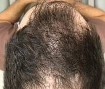 Platelet-Rich Plasma Before and After Case 2 After