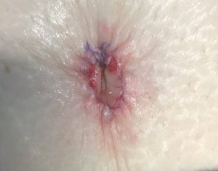 Keloids Before and After Case 4 Before