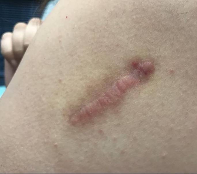 Keloids Before and After Case 5 Before