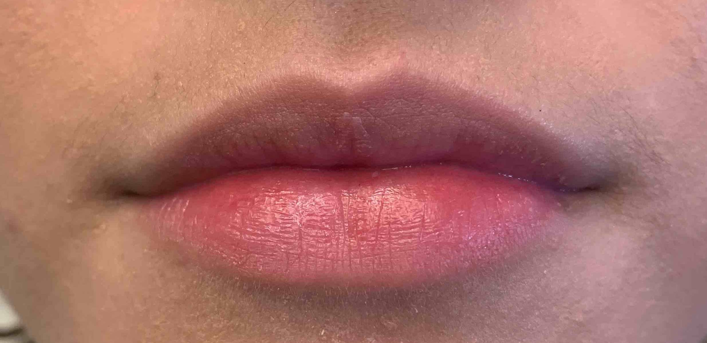 Juvederm (1 Syringe) Case 15 Before