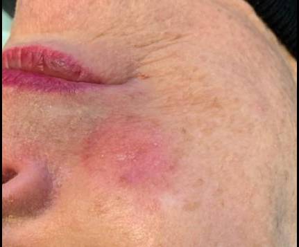 Skin Cancer Before and After Case 11 After