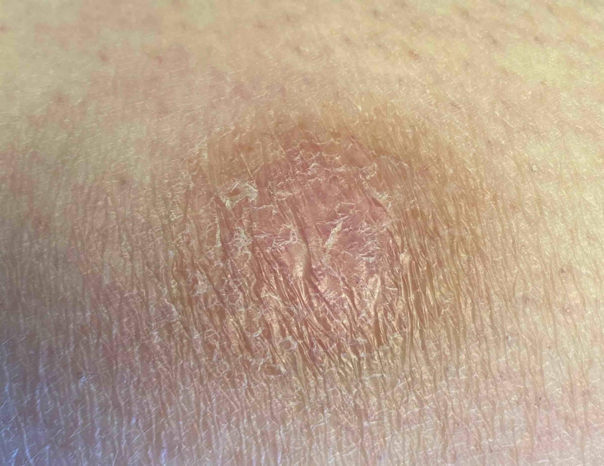 Skin Cancer Before and After Case 13 After