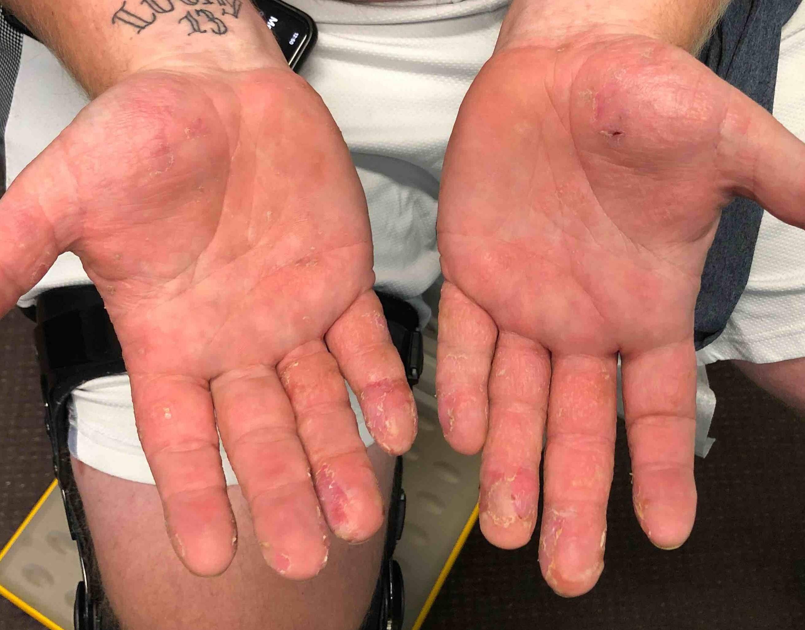 Eczema/ Atopic Dermatitis Before and After Case 11 After