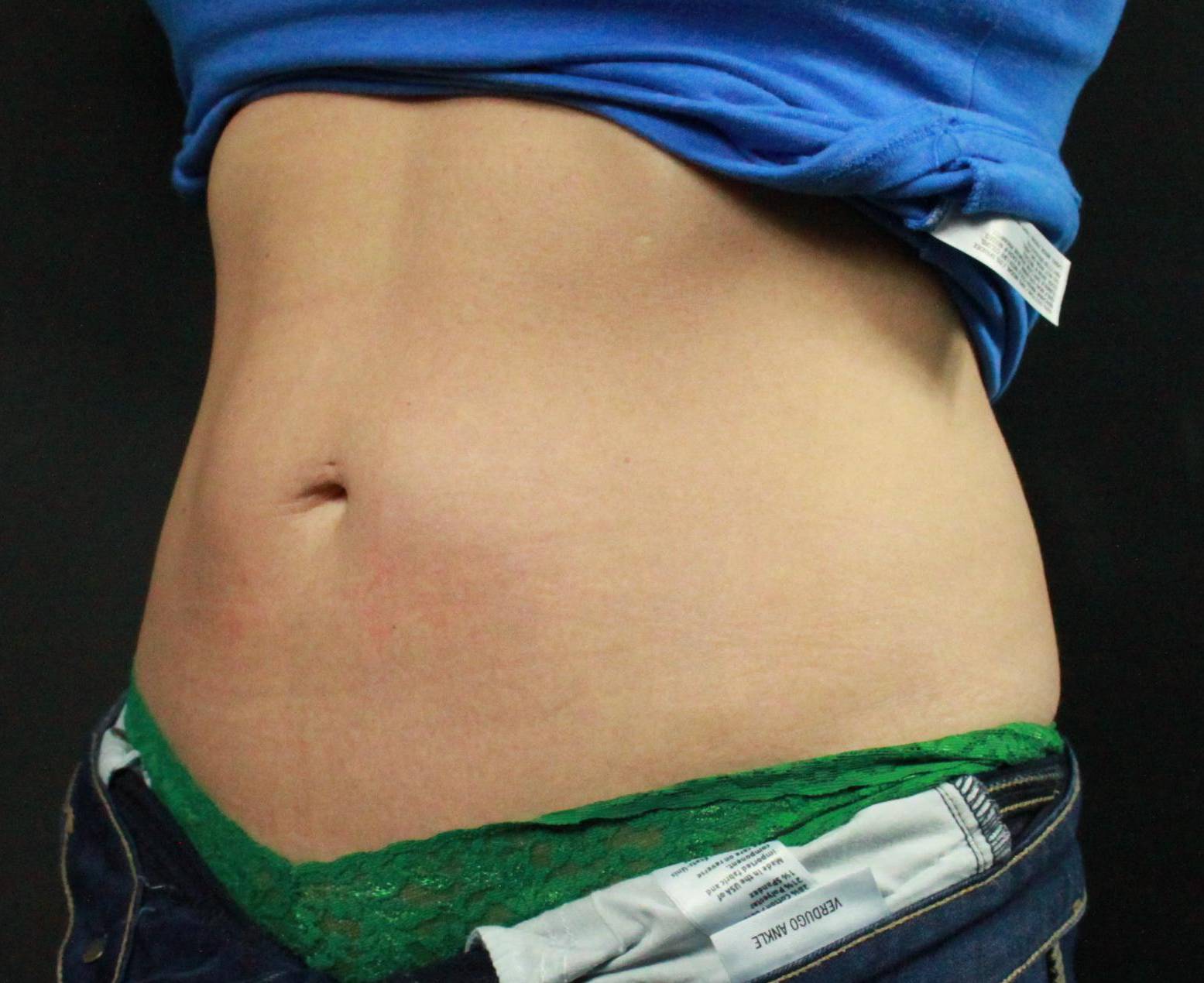 CoolSculpting<sup>®</sup> Before and After Case 15 After