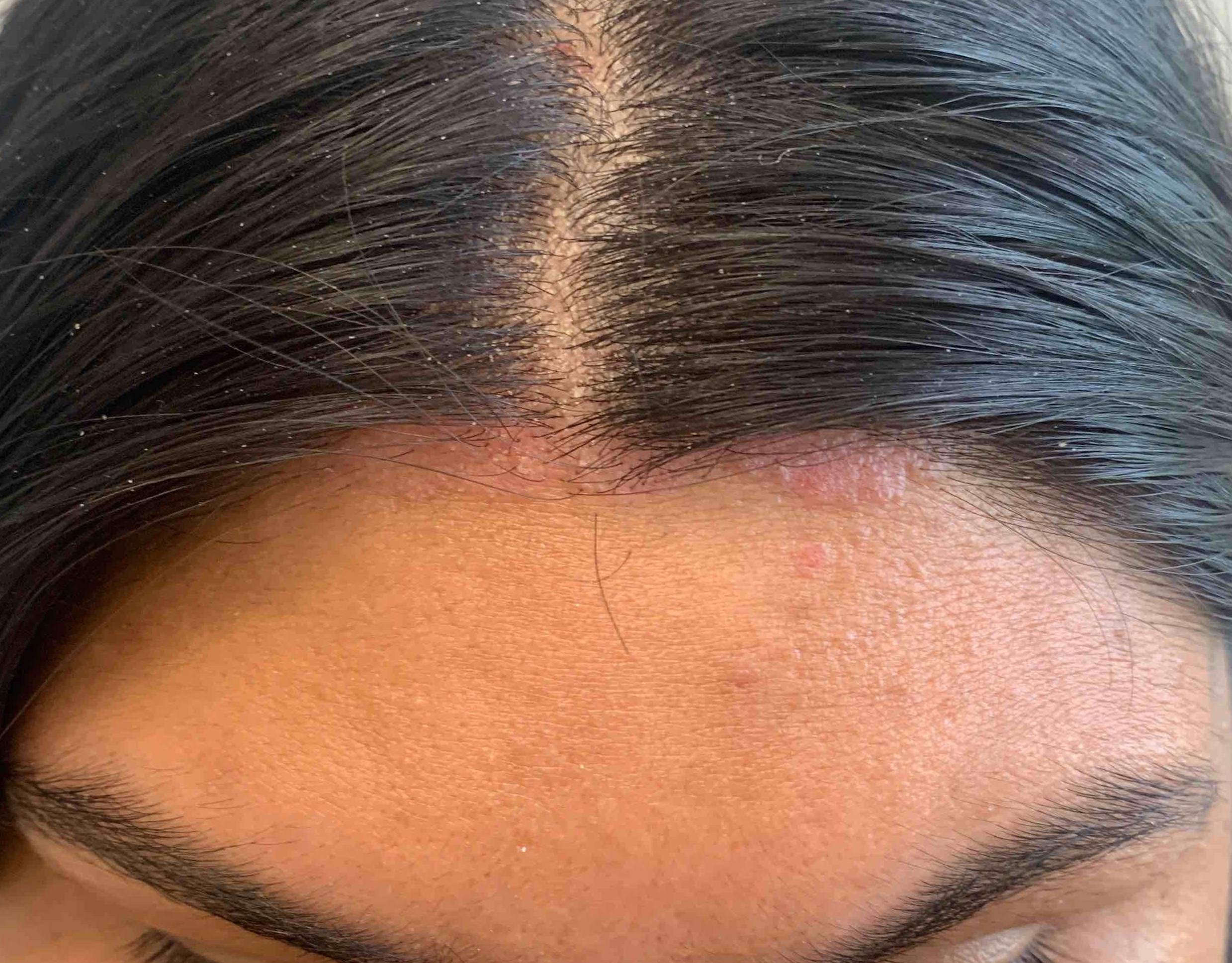 Psoriasis Before and After Case-29 Before
