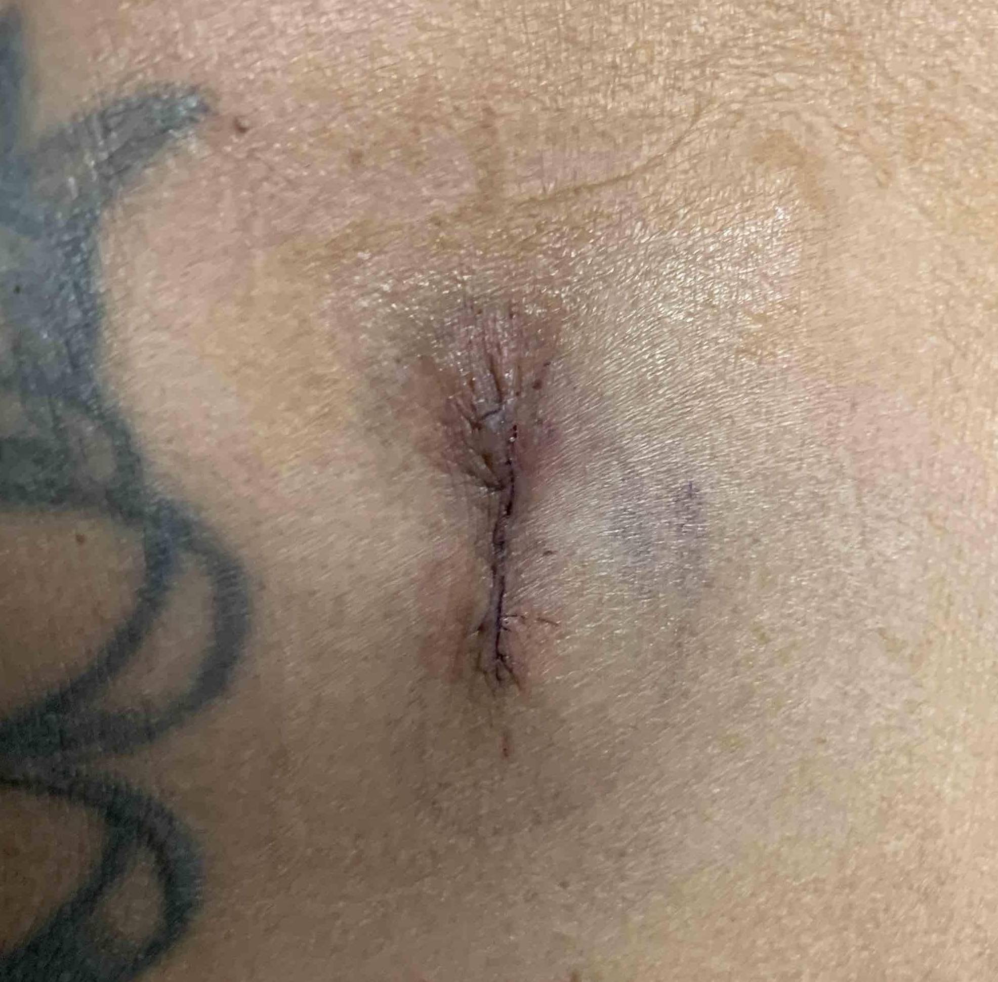 Keloids Before and After Case 13 Before