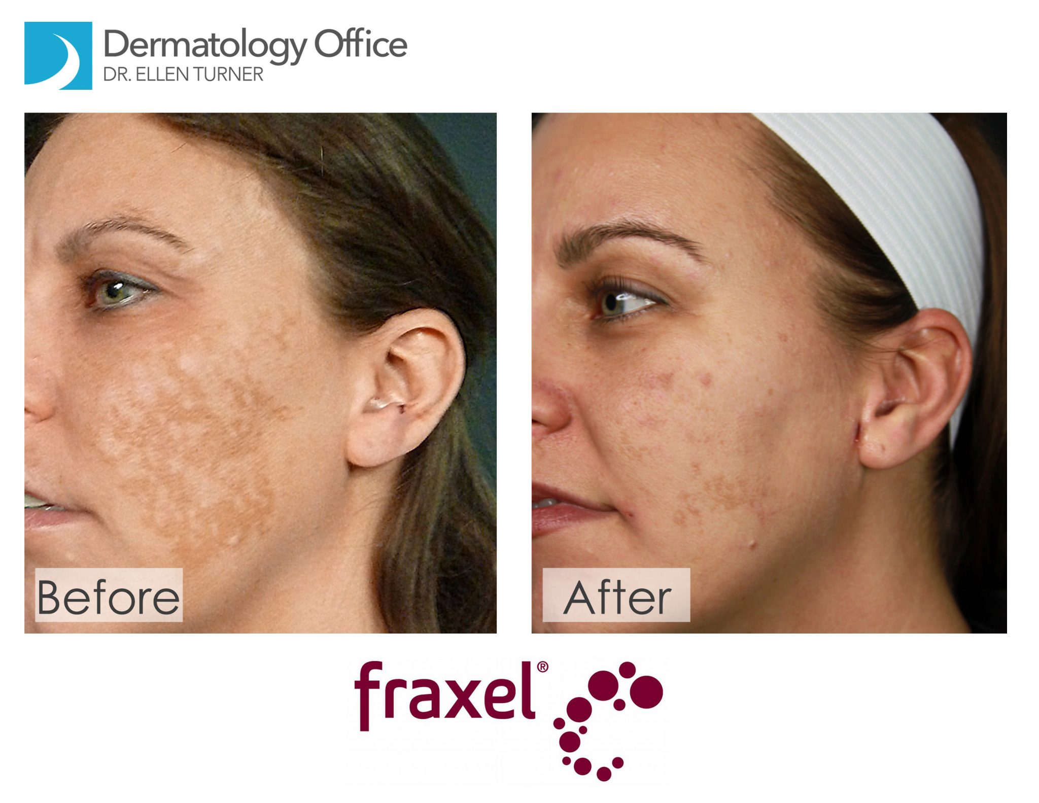 Laser Skin Resurfacing Fraxel Laser Dallas Area Dr Ellen Turner 7546