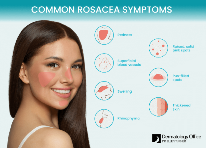 Rosacea treatment | Dr. Ellen Turner in the Dallas area, including Plano