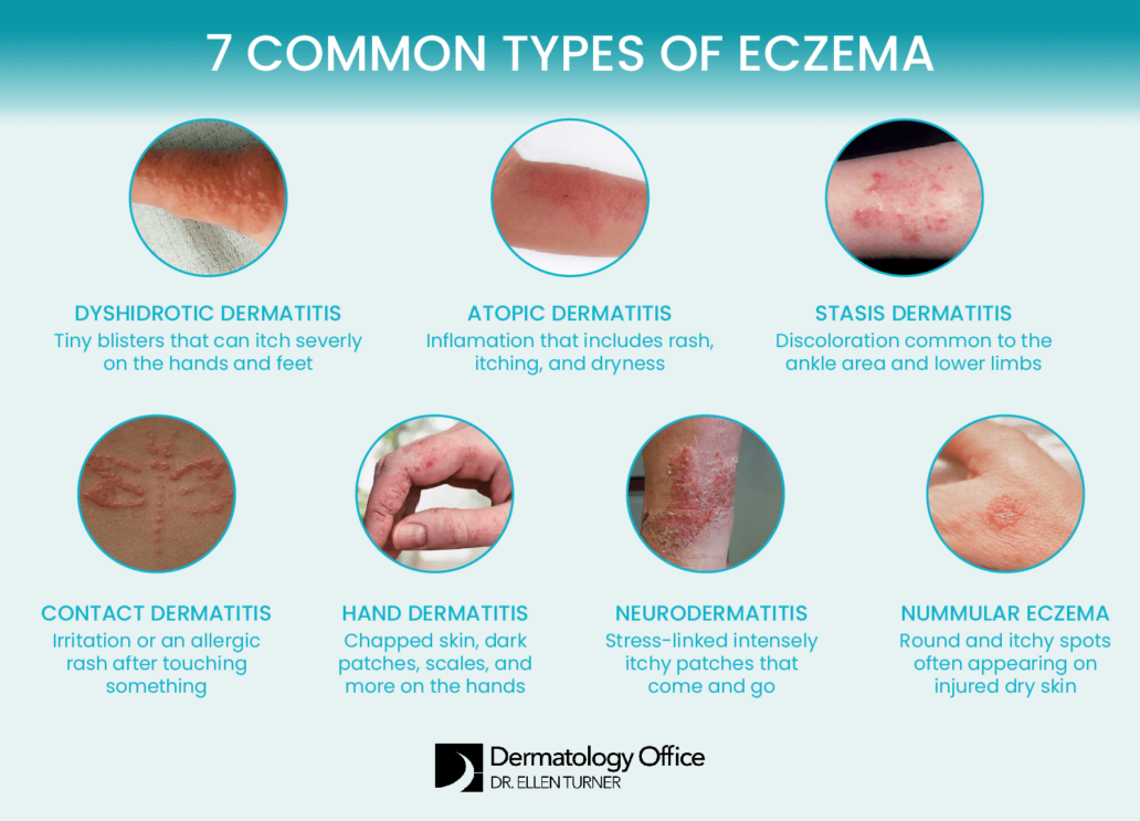 Eczema treatment in the Dallas area | Dr. Ellen Turner